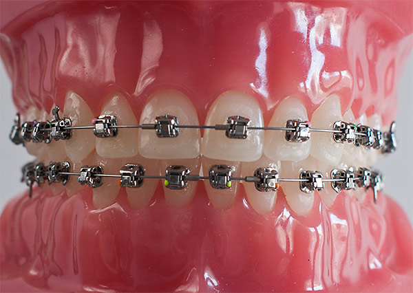 Bagues métalliques
