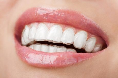 Gouttières invisibles Invisalign