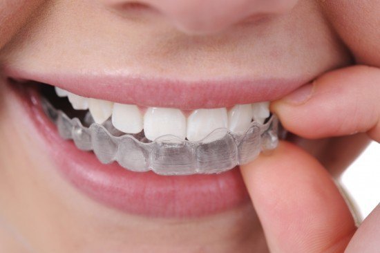 Orthodontie adulte